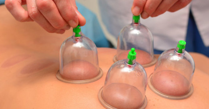 Le cupping : efficacité, limites et usage sécuritaire