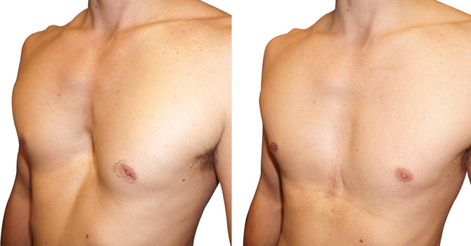 Pectus excavatum