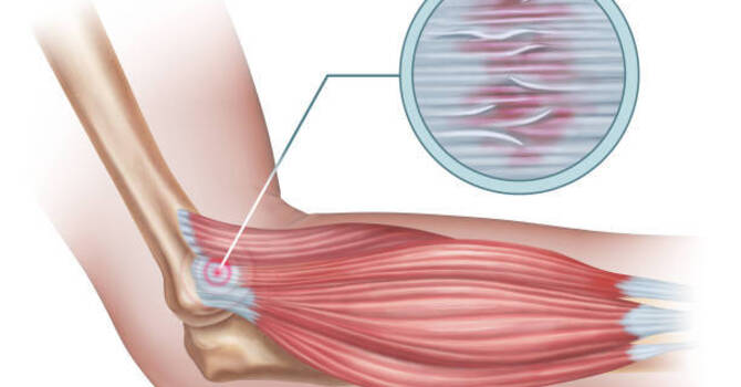 Adapter les tendons : exercices, charges et progression
